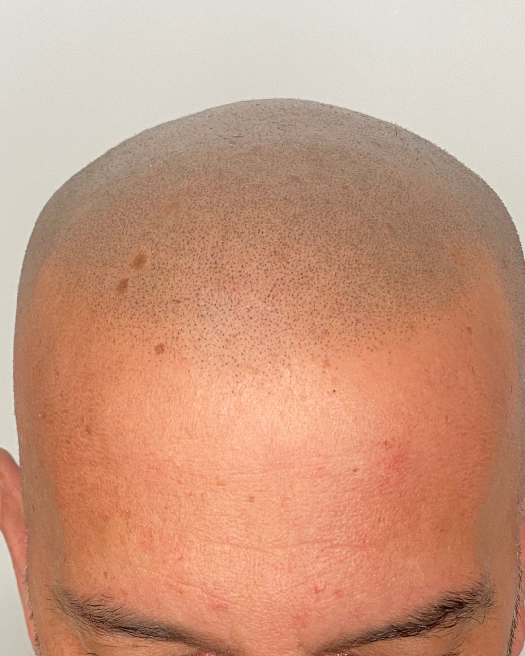Después — Línea Frontal